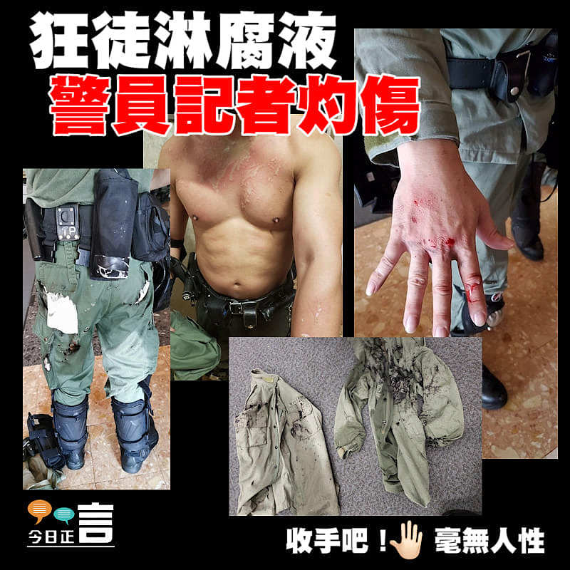 狂徒淋腐液 警員記者灼傷