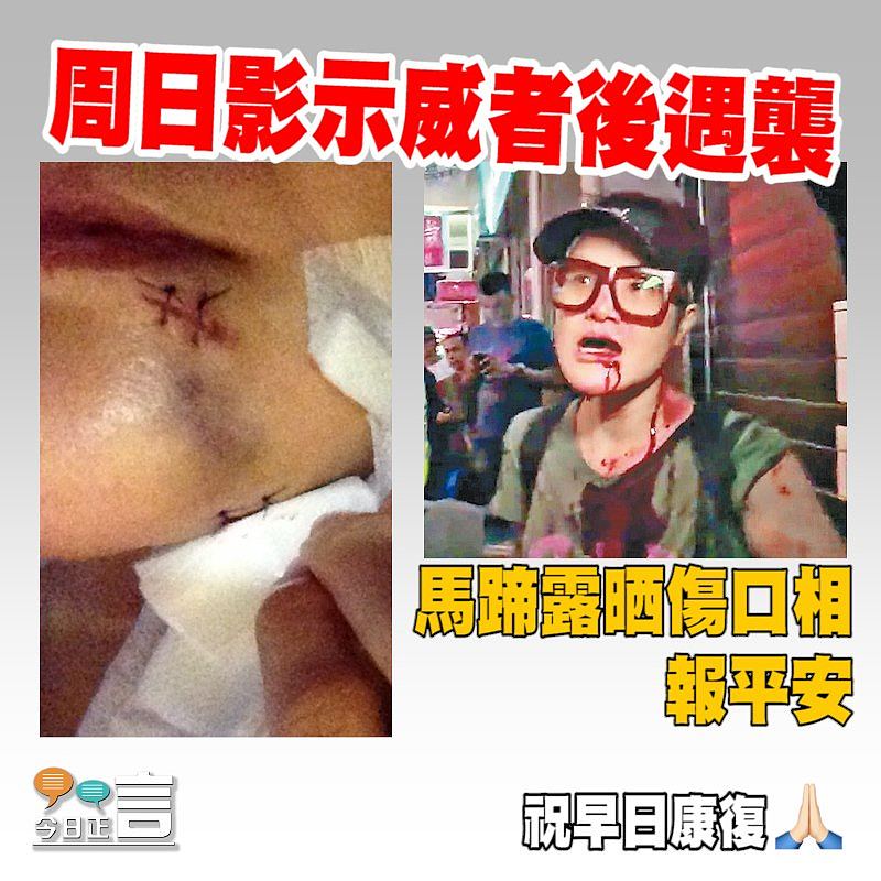 馬蹄露晒傷口相報平安