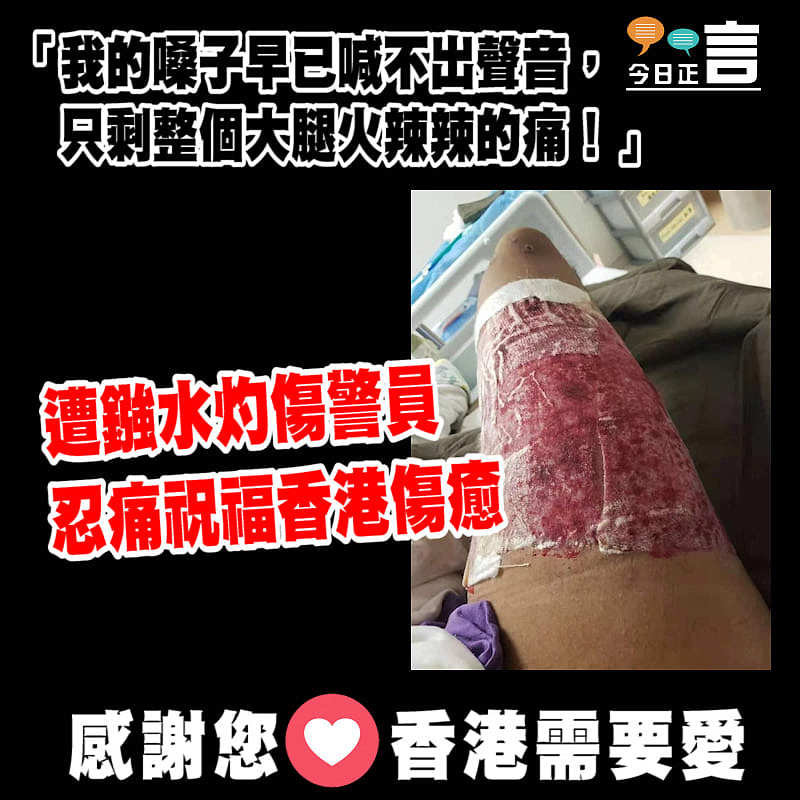 遭鏹水灼傷警員 忍痛祝福香港傷癒