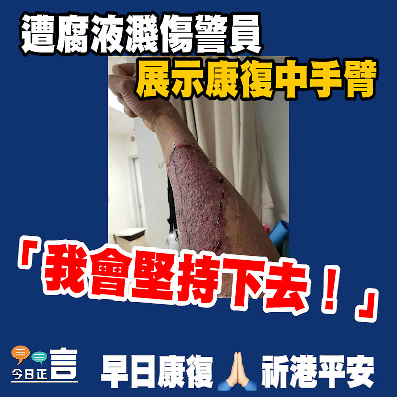 遭腐液濺傷警員展示康復中手臂