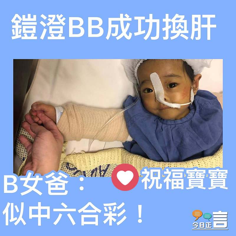膽管閉鎖1歲B女成功換肝
