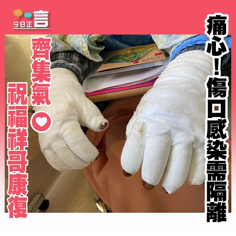 被焚祥哥傷口受感染要隔離