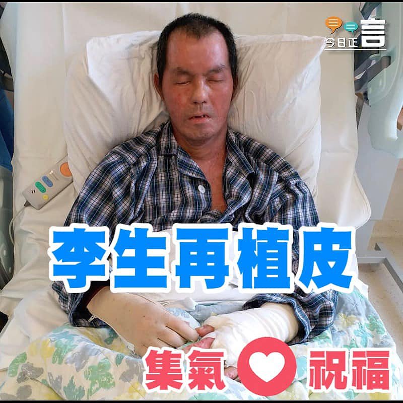 被焚李生正排期做第四次植皮手術