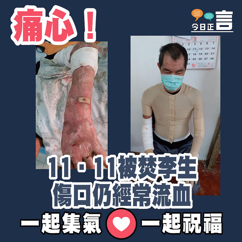 11‧11被焚李生傷口仍經常流血