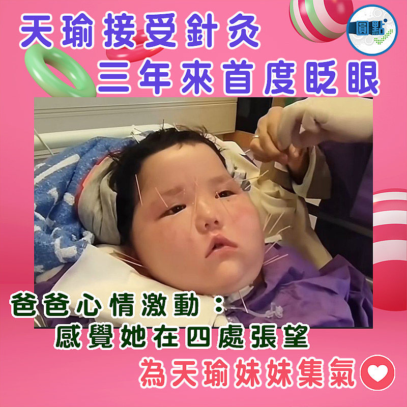 天瑜接受針灸三年來首度眨眼　爸爸心情激動：感覺她在四處張望