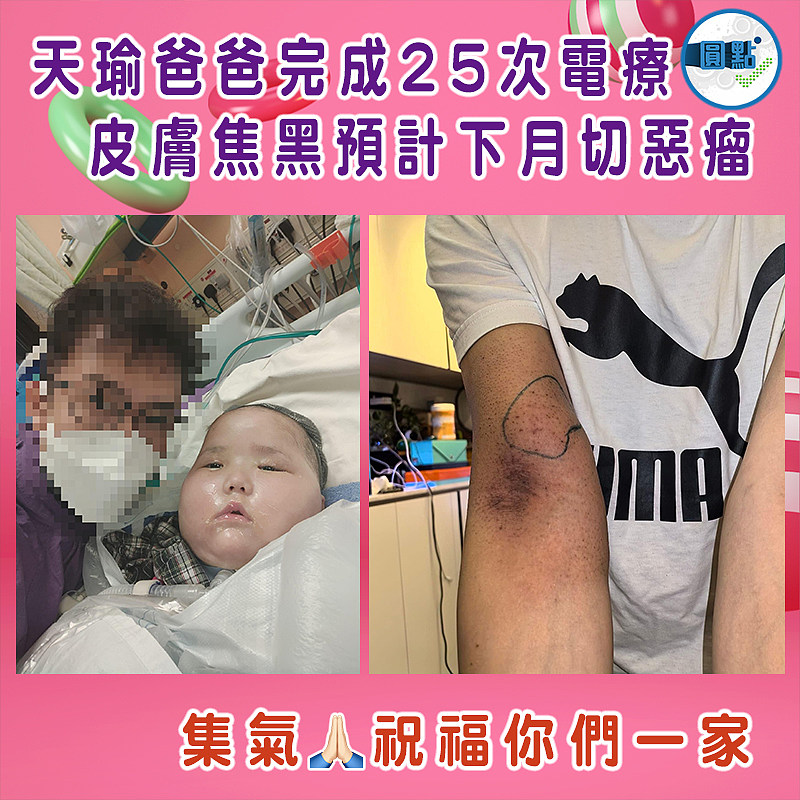 天瑜爸爸完成25次電療 皮膚焦黑預計下月切惡瘤