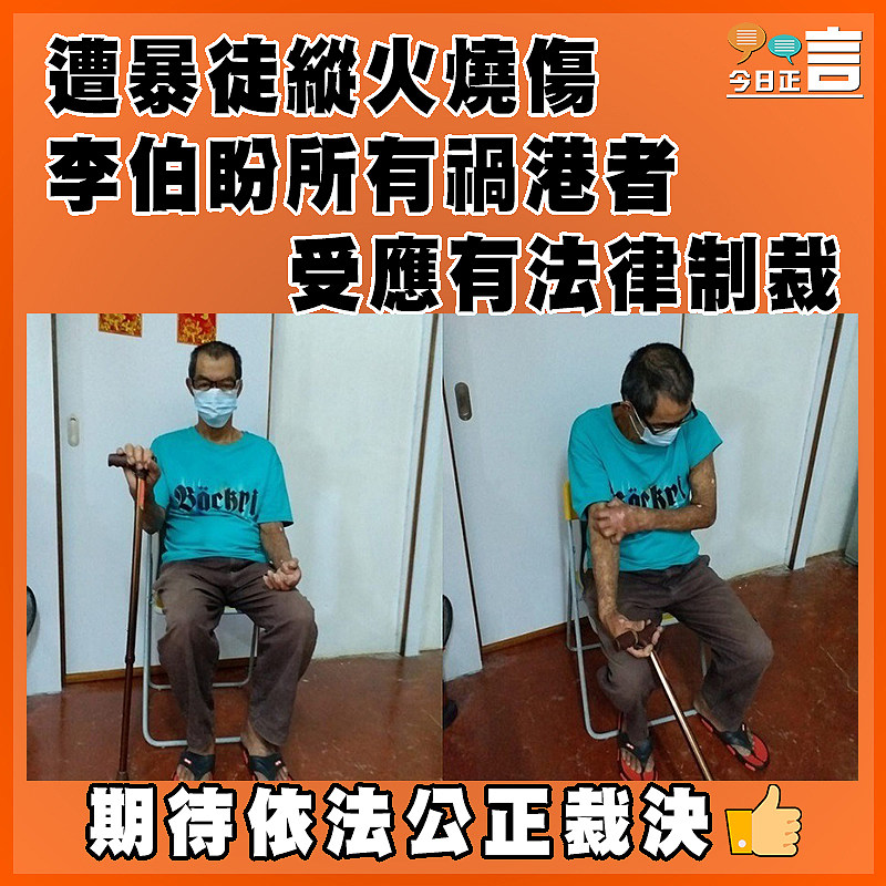 遭暴徒縱火燒傷  李伯盼所有禍港者受應有法律制裁