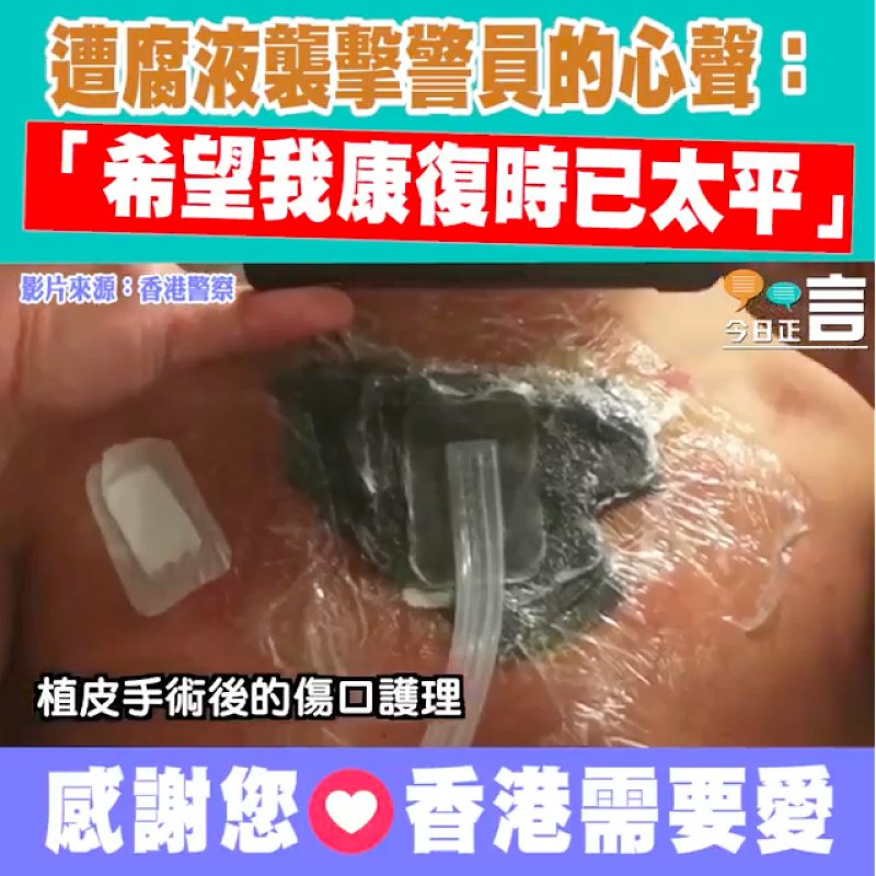 遭腐液襲擊警員的心聲：「希望我康復時已太平」