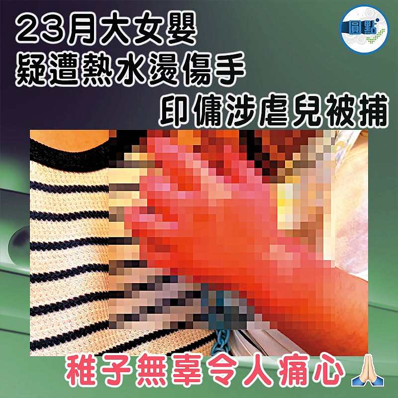 23月大女嬰疑遭熱水燙傷手 印傭涉虐兒被捕